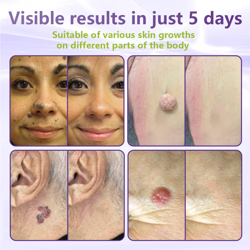 💖BUY 2 GET 1 FREE -✨LOVILDS™ SOLUBLE MICRONEEDLE BOTANICAL SKIN TAG REMOVAL PATCH