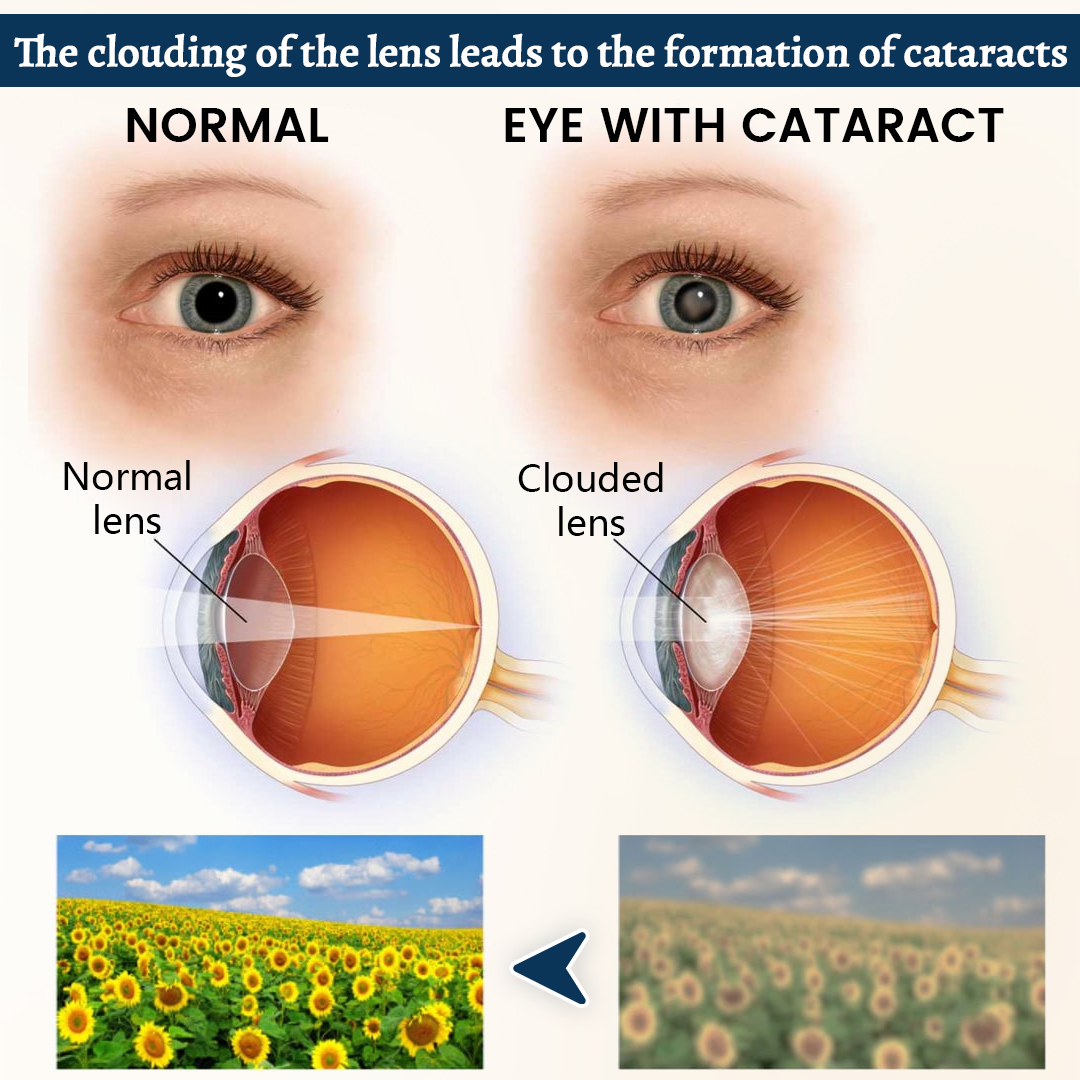 QIAWI® OptiFusion Vision Support Eye Patch👁️✨