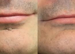 ✨2-in-1 Microneedle & Hydrocolloid Patch🍀| Invisible Patches for Face & Body