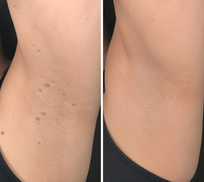 ✨2-in-1 Microneedle & Hydrocolloid Patch🍀| Invisible Patches for Face & Body
