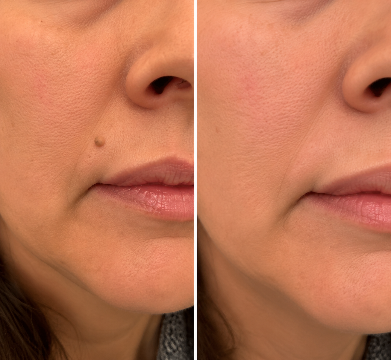 ✨2-in-1 Microneedle & Hydrocolloid Patch🍀| Invisible Patches for Face & Body