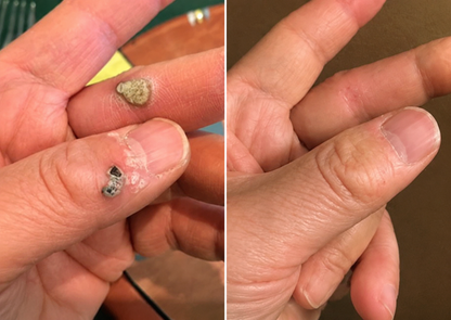 ✨2-in-1 Microneedle & Hydrocolloid Patch🍀| Invisible Patches for Face & Body