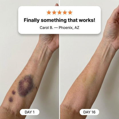 💥Buy 1 Get 1 Free💕- ROVINAO® Bruise Repair & Skin-Strengthening Cream